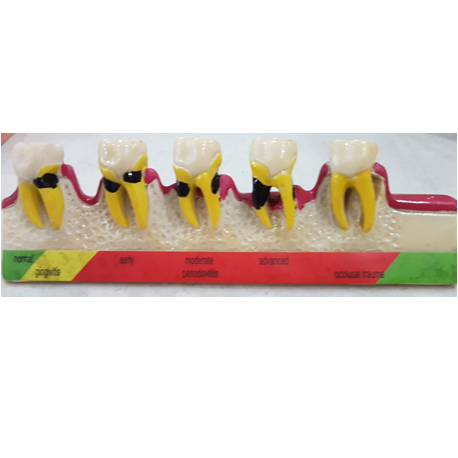 Study Model Demonstrating Gingival and Periodontal Pathologies